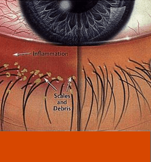BLEPHARITIS