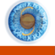 Keratoconus