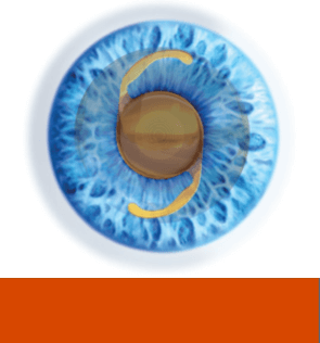 Keratoconus